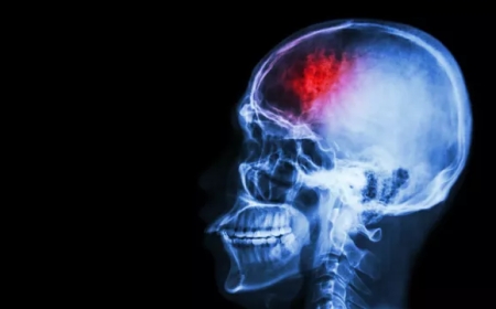 Российские ученые нашли ген, отвечающий за тяжесть инсульта